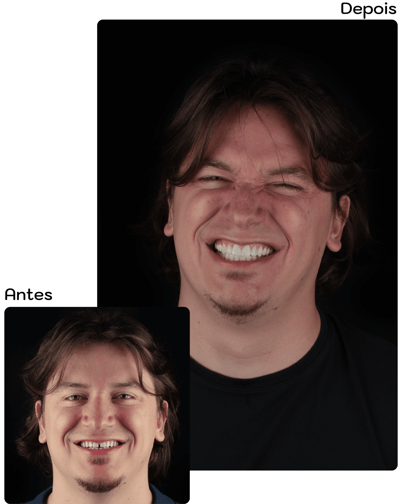 Comparação de sorriso antes e depois do tratamento com Dra. Lara Toledo
