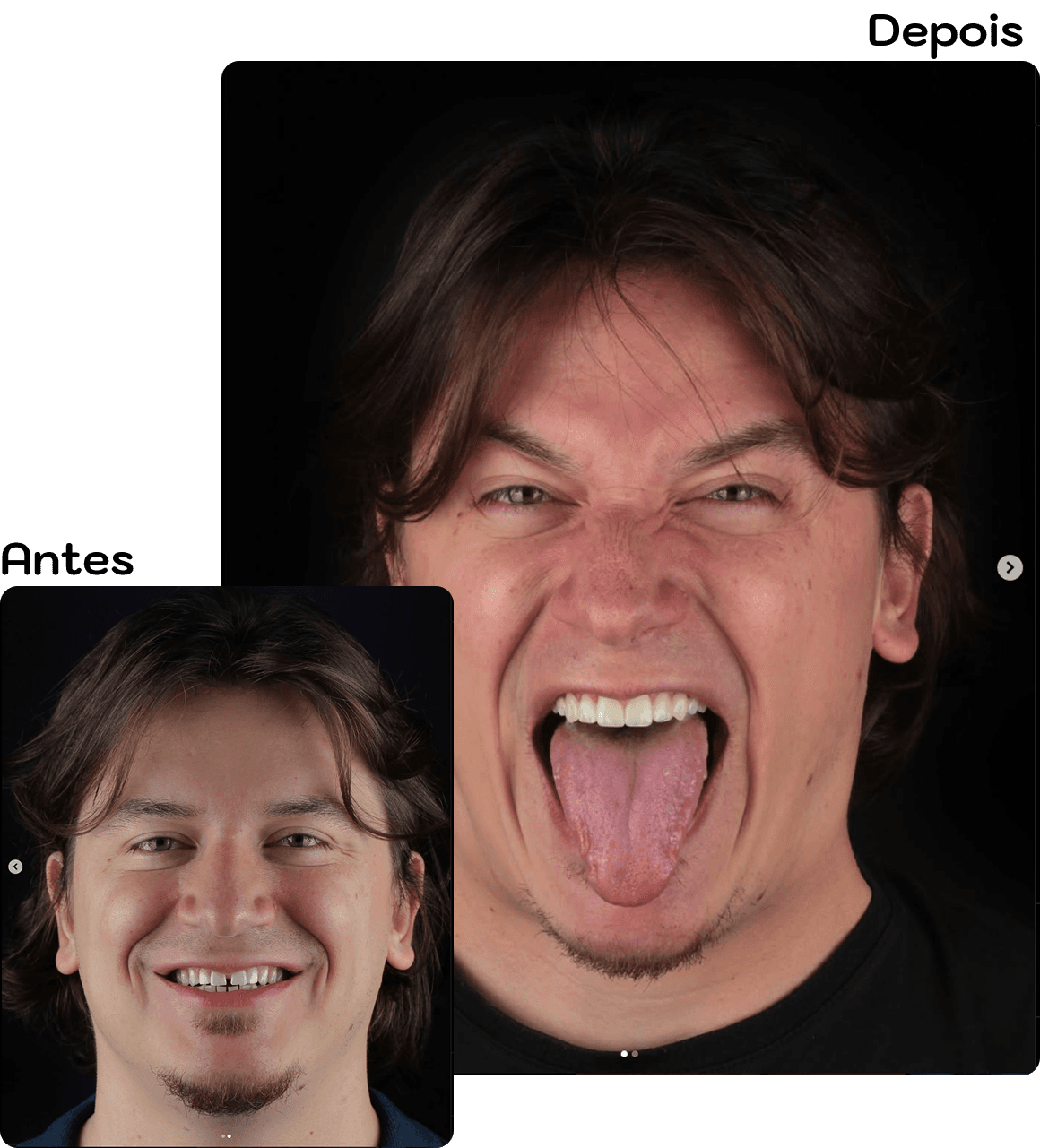 Comparação de sorriso antes e depois do tratamento com Dra. Lara Toledo